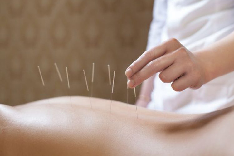 acupuncture coquitlam treatment