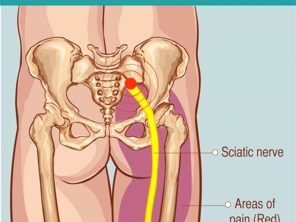 Iliotibial Band Syndrome - What it is, and how to manage it!