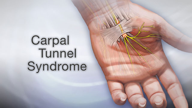 Carpal Tunnel Syndrome - Trinity Chiropractic